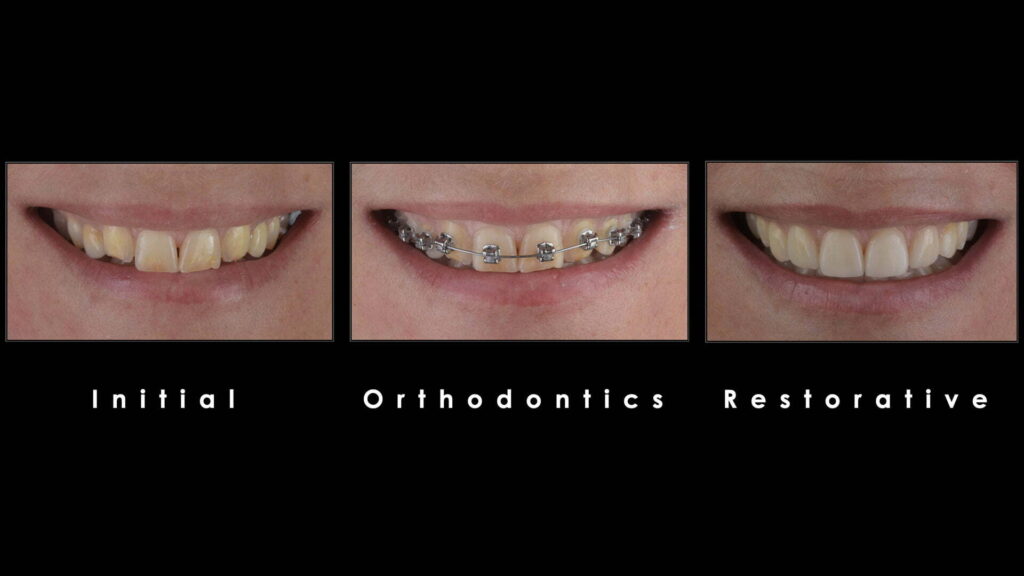 טיפול משולב של יישור שיניים ושיקום