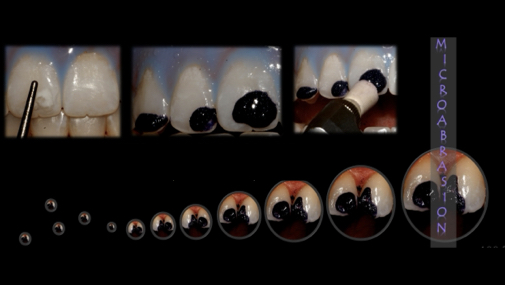 הסרת כתמים מהשיניים בשיטת מיקרו-אברזיה – פרק 2 מתוך 2